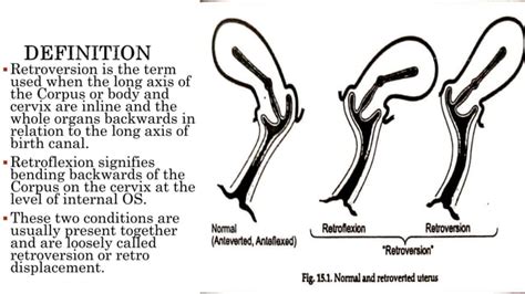Retroverted Uterus: Importanteng Impormasyon .
